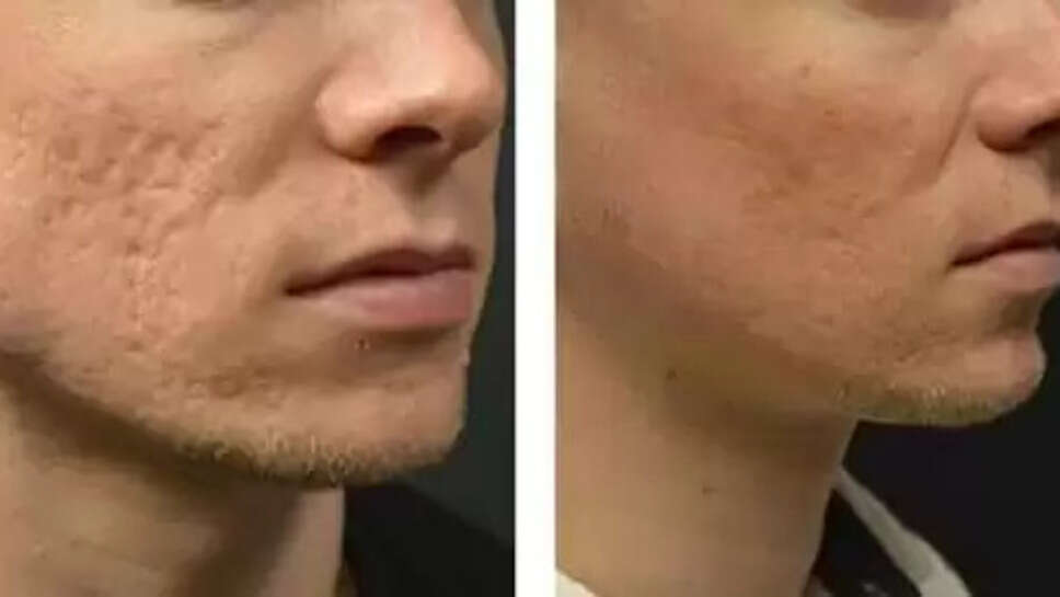  Face Scar