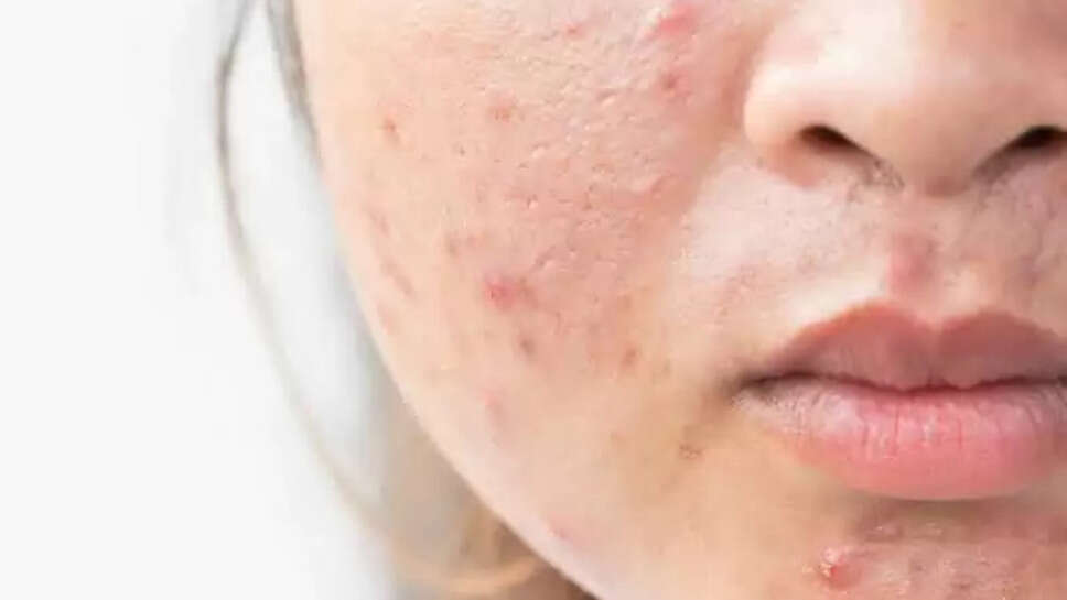 Best Home Remedies Get Rid Of Acne Scars