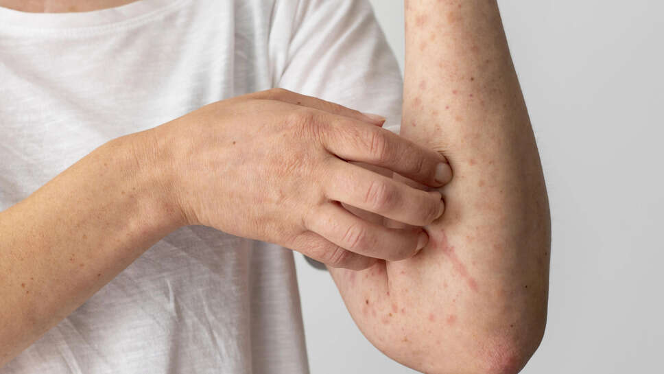  Top 5 Creams For Fungal Infections In 2023