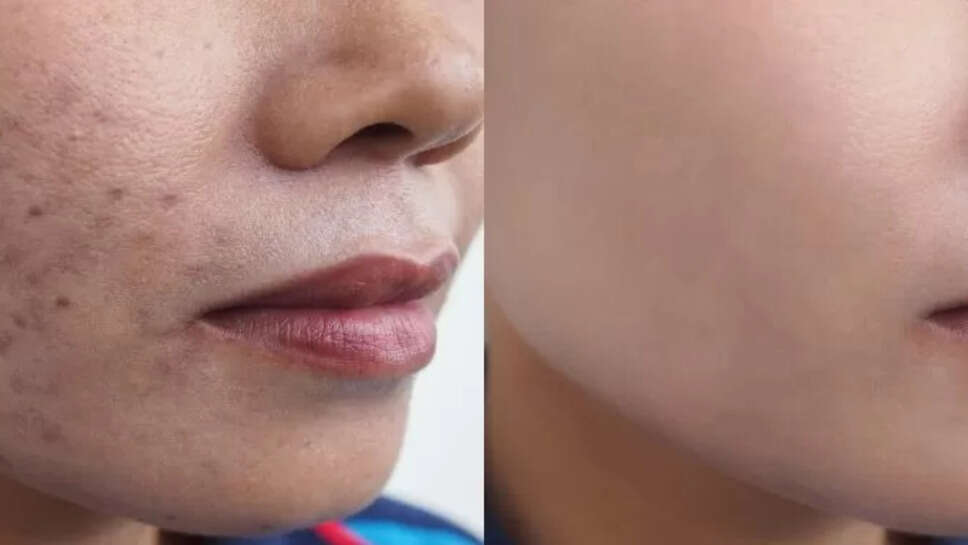 Top 6 Creams For Chicken Pox Scars