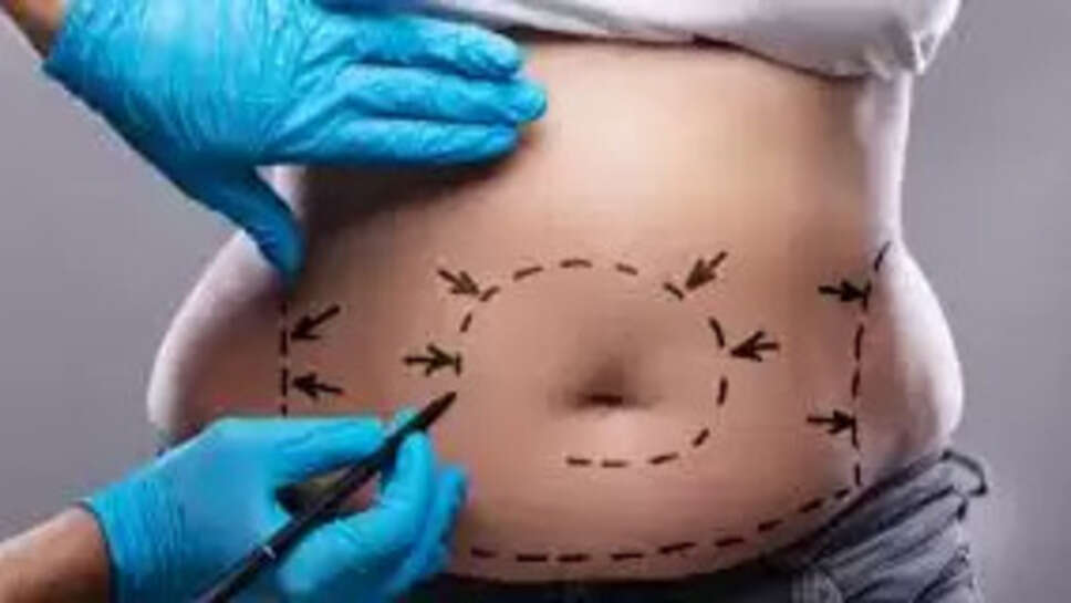 Liposuction